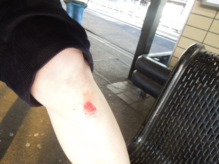 The Damage To My Left Leg